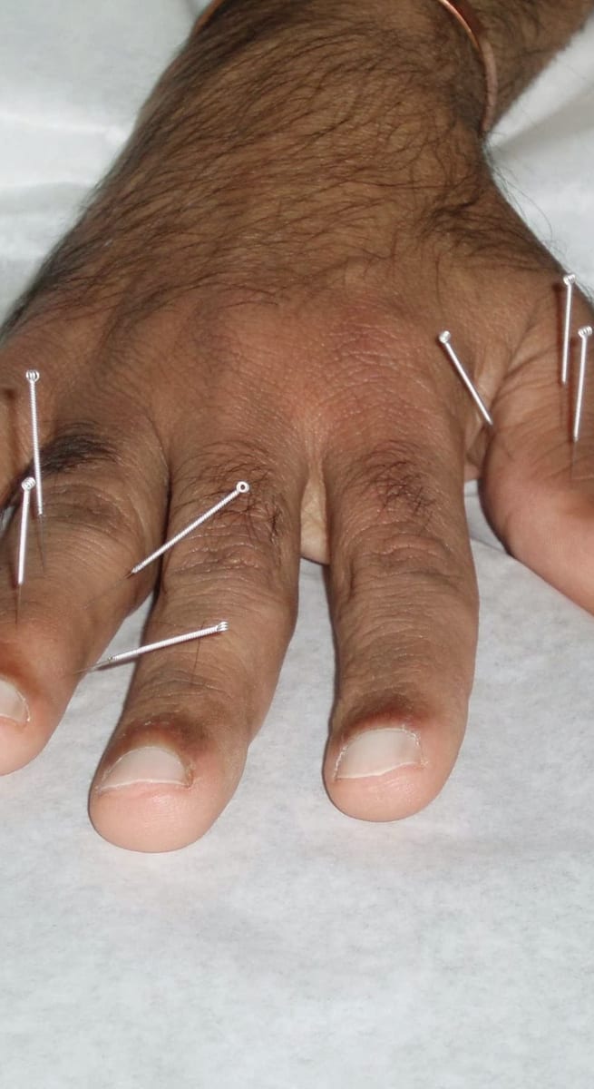 Acupuncture needles placed along the back of a patient's hand on a treatment couch